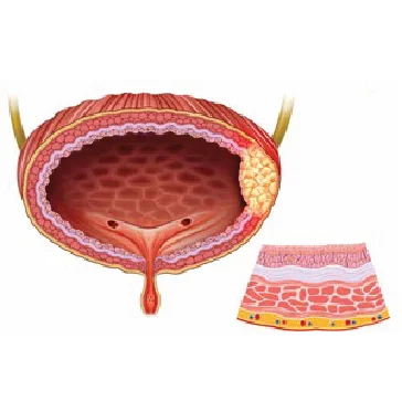 Bladder Cancer: An overview